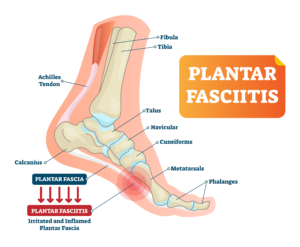 heel pain in adults