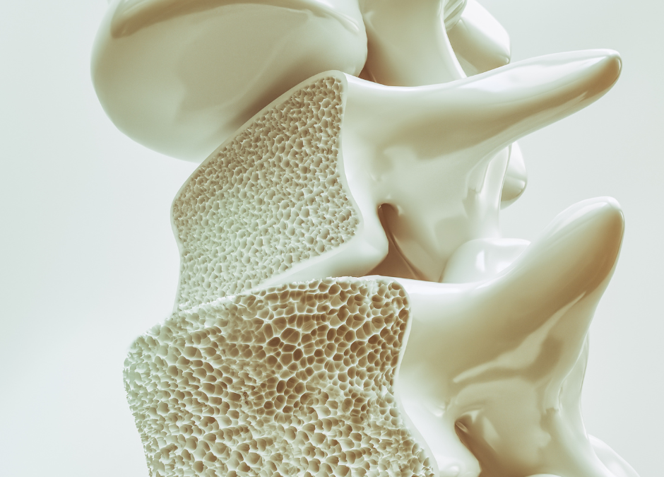 Treatment for Osteoporosis: The 5 Exercise Benefits You Need